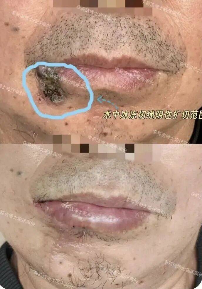 57岁男子把唇上肿瘤当痘痘挤了8年，医生提醒